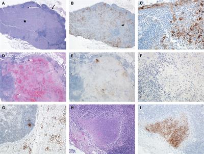 An atlas of gross and histologic lesions and immunohistochemical immunoreactivity during the temporal progression of aerosolized Lassa virus induced hemorrhagic fever in cynomolgus macaques